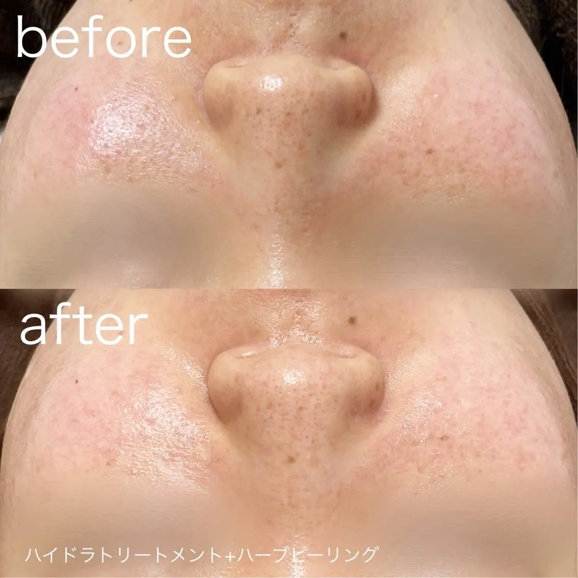 脱毛 lulularico Yuのネイルデザイン