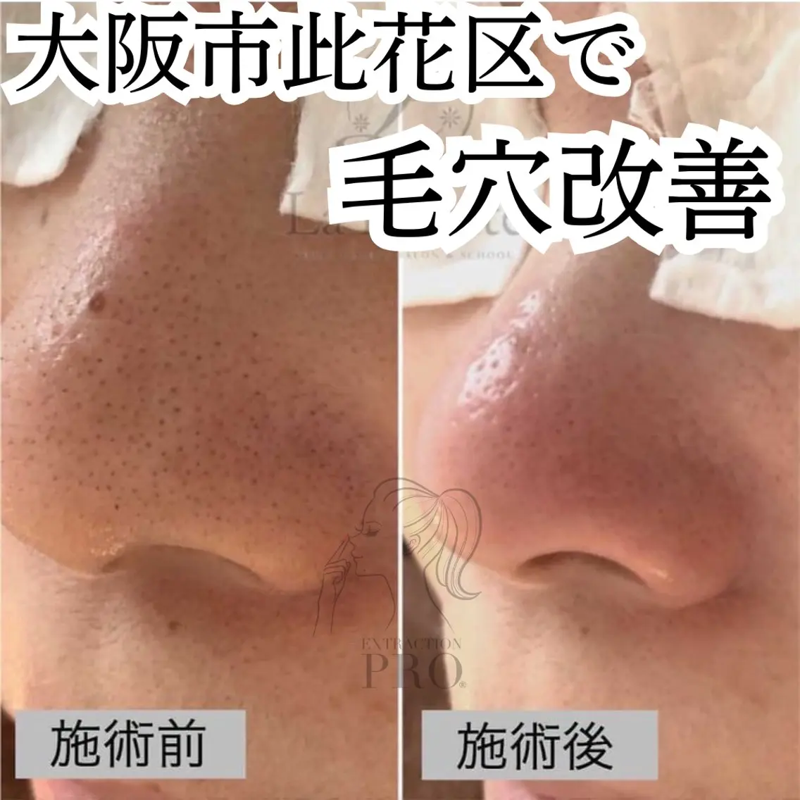 【ミニモ限定】毛穴ごっそり洗浄コース　通常12,000円→8,800円の写真