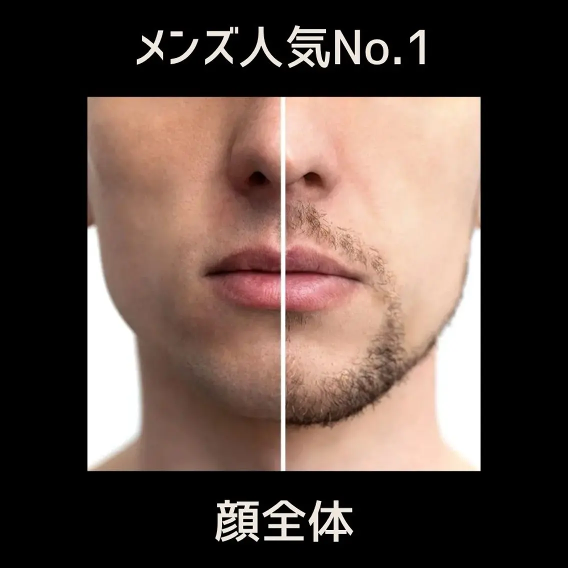 【男性人気】毎朝の髭剃りを楽に!顔全体脱毛の写真