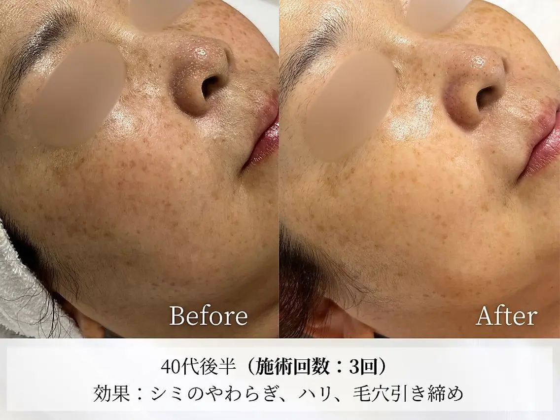 【シミ、シワの集中ケア】最新韓国施術！XE LHAピール💎シミ改善、シワケア、色素沈着、ニキビケア、毛穴の黒ずみにも！の写真