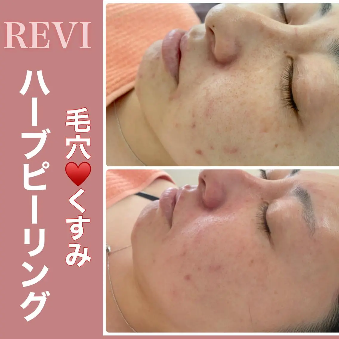 REVI取扱・肌悩み 毛穴Chalonのエステ・リラクイメージ