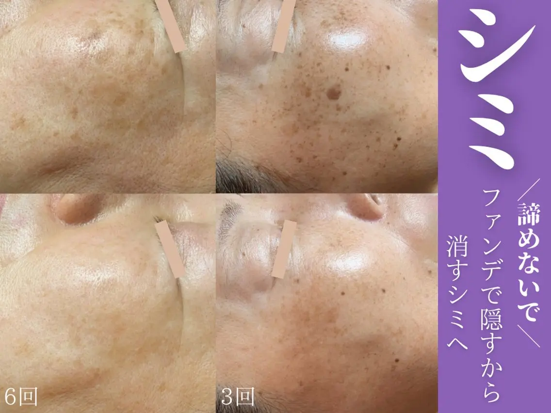 【シミケア初回★圧倒的No.1人気】気になるシミに20分当て放題!通常16,000 → 初回5,500の写真