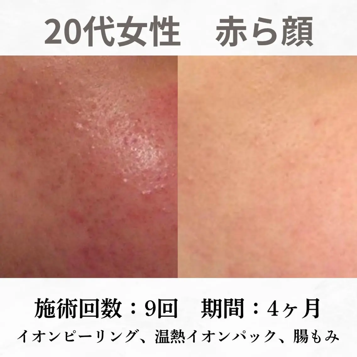 重度ニキビ専門🌼 ダウンタイムなしのエステ・リラクイメージ