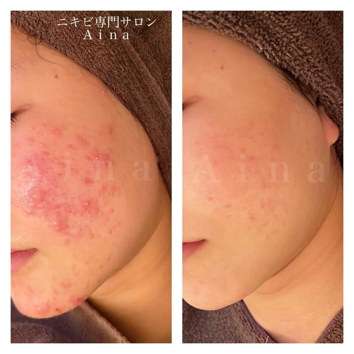 セミロング パーマ ヘアアレンジ メンズ キッズ ネイル マツエク・マツパ アイブロウ エステ リラク ニキビ跡専門サロン Ainaのエステ・リラクイメージ