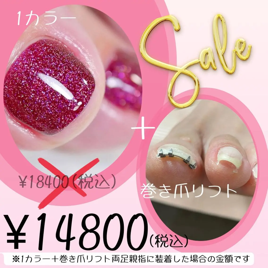 1カラー+巻き爪リフト(両足親指)の写真