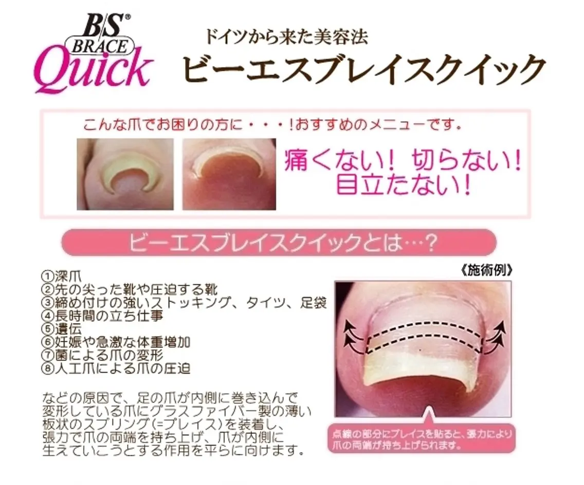 夏に向けて今からいかがですか？(B/Sブレイス巻き爪矯正)練習モデル様募集🫧　片足🦶🏻💛の写真
