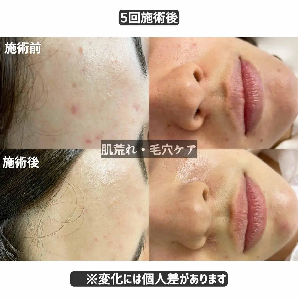 【繰り返すニキビ・毛穴詰まりに】青色LED×毛穴洗浄×美容鍼 60分の写真