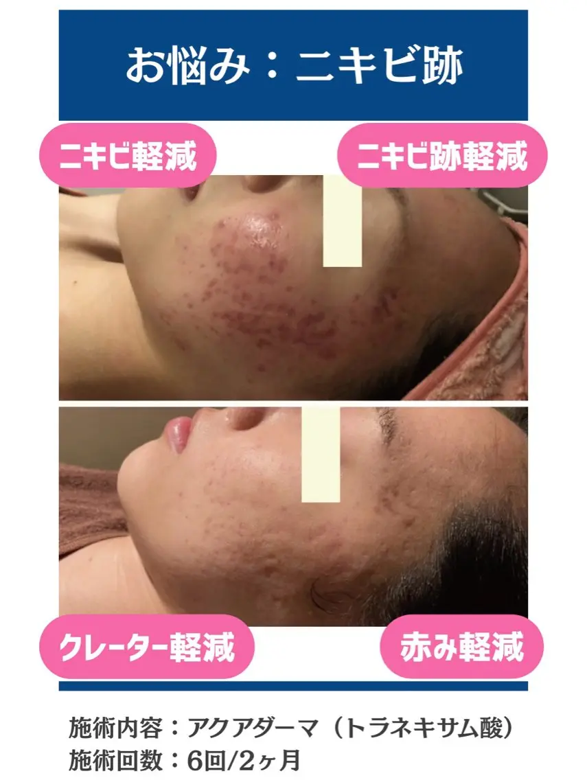 毛穴レス美肌へ🌿 看護師Abe🌼のエステ・リラクイメージ