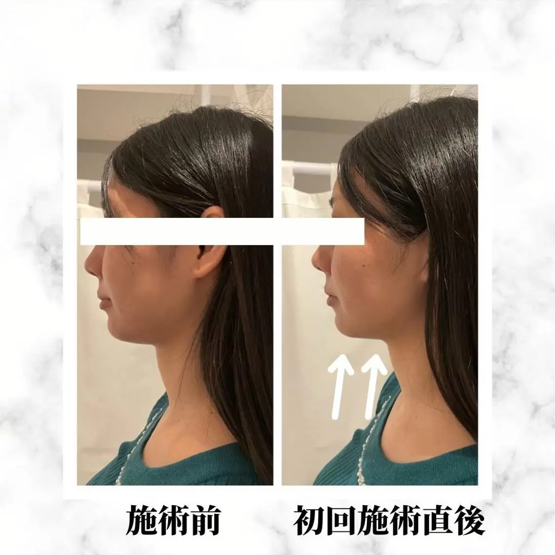 12Dハイフ💗 最強小顔のエステ・リラクイメージ