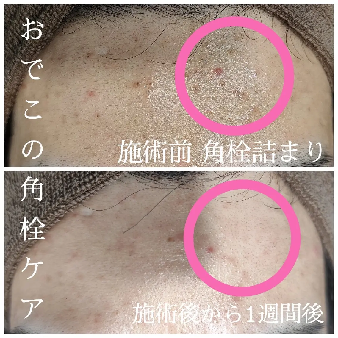 シミそばかす/ニキビ/ニキビ跡に！光フォトの写真