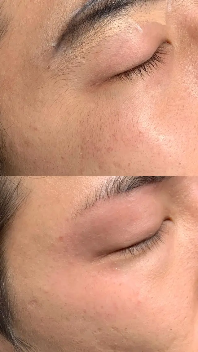 メンズ アイブロウ 眉毛ワックス脱毛 iBROW. 熊見怜奈の眉毛・アイブロウイメージ