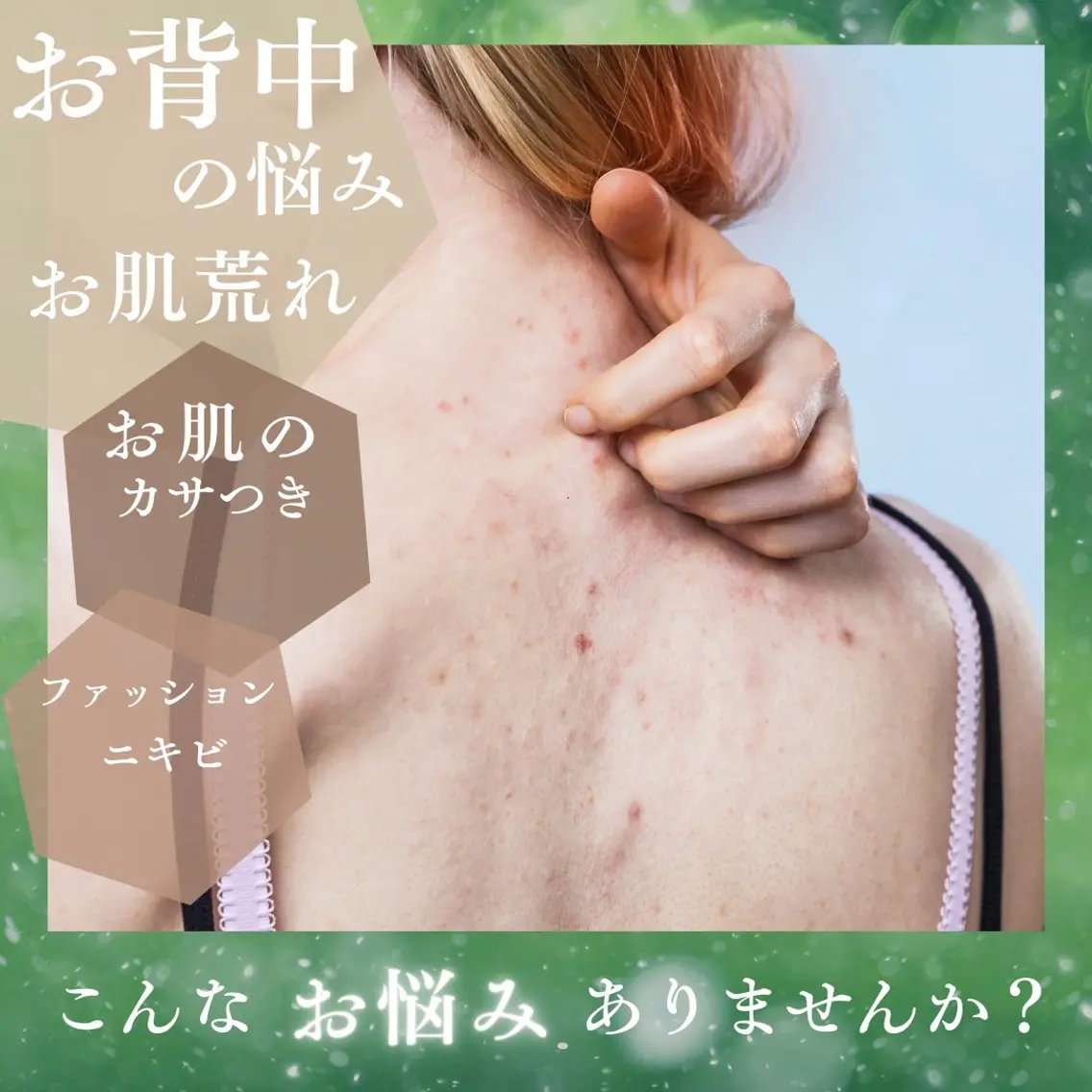 背中のハーブピーリング🌿【ニキビ/ニキビ跡/黒ずみ/くすみ】の写真