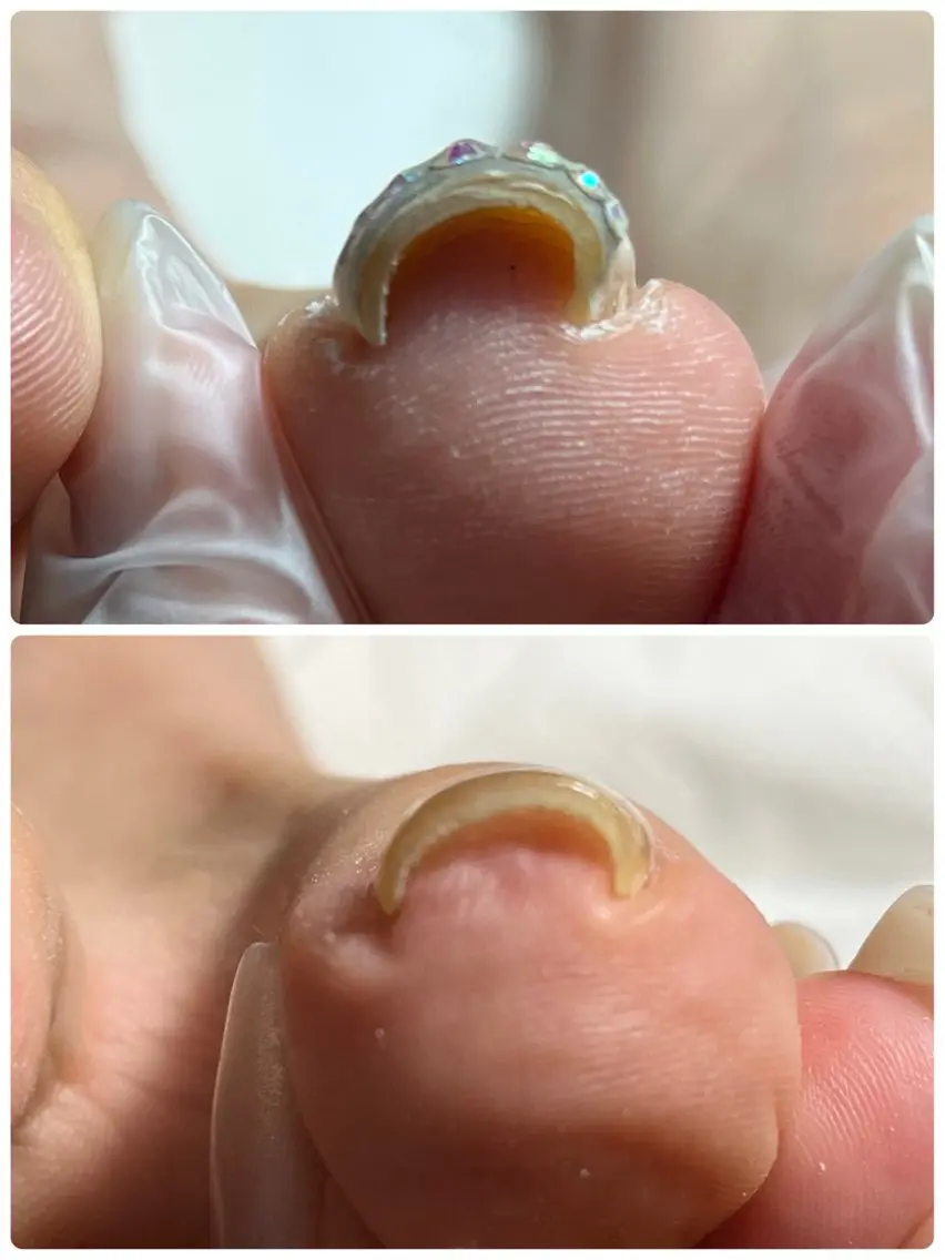 巻き爪矯正ジェルの写真