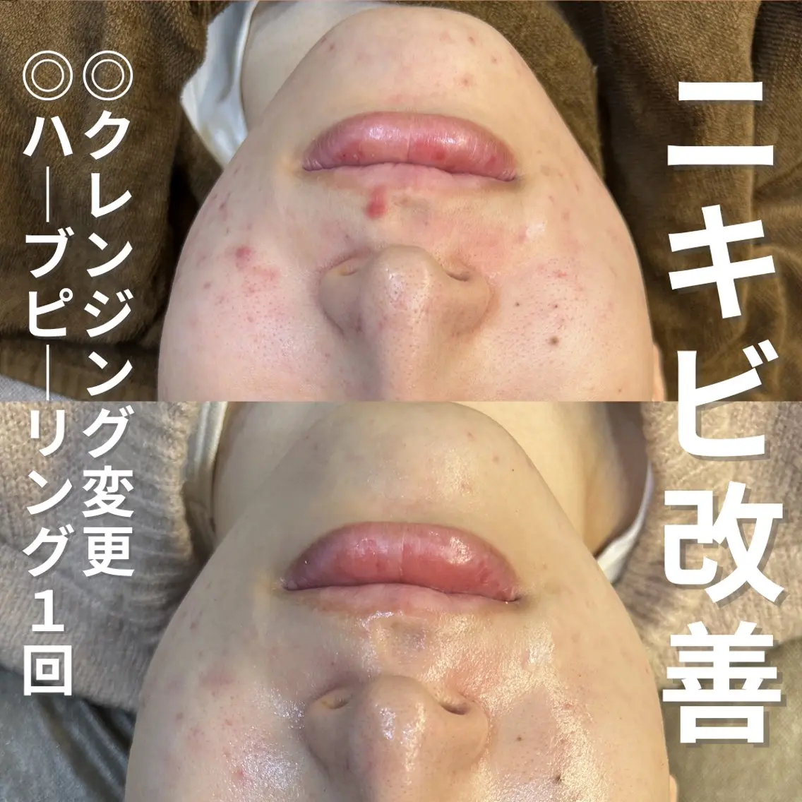 エステ ニキビ・ニキビ跡改善 leoloのエステ・リラクイメージ