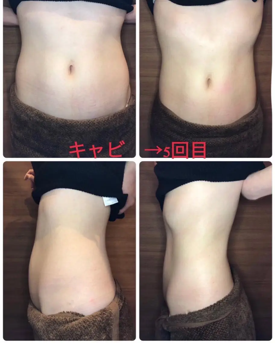 サイズダウン痩身キャビテーション(1パーツ)   Dr.Jエヴォリューション！¥3000の写真