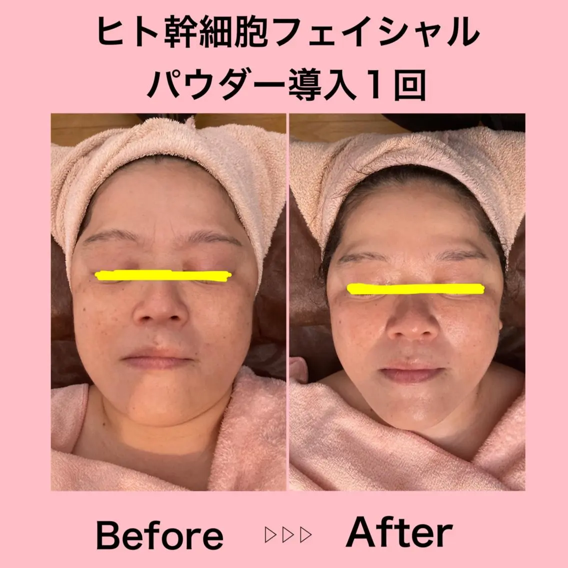 ヒト幹細胞フェイシャルパウダー導入コースの写真