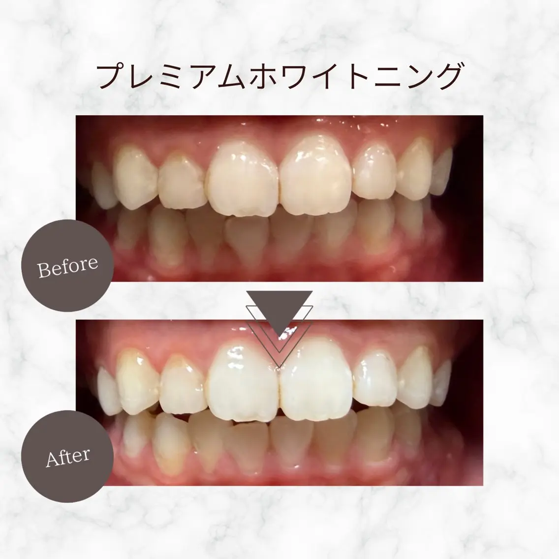 【人気No.1◎】プレミアムホワイトニング 9分×4回照射 リップマスク付♪の写真