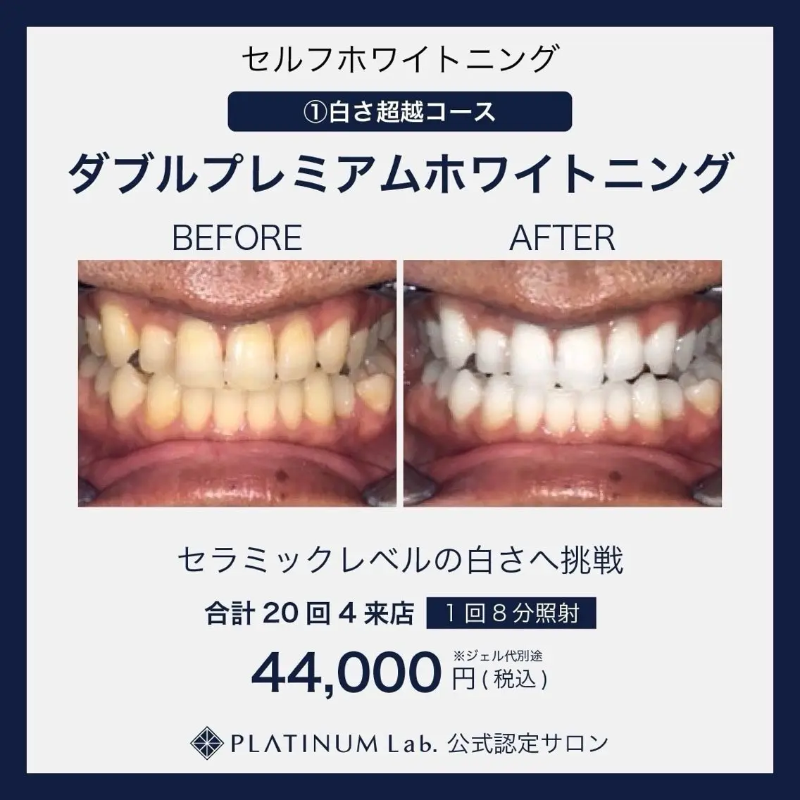 【ダブルプレミアムホワイトニング合計160分4来店分】白い歯を目指したい方への写真