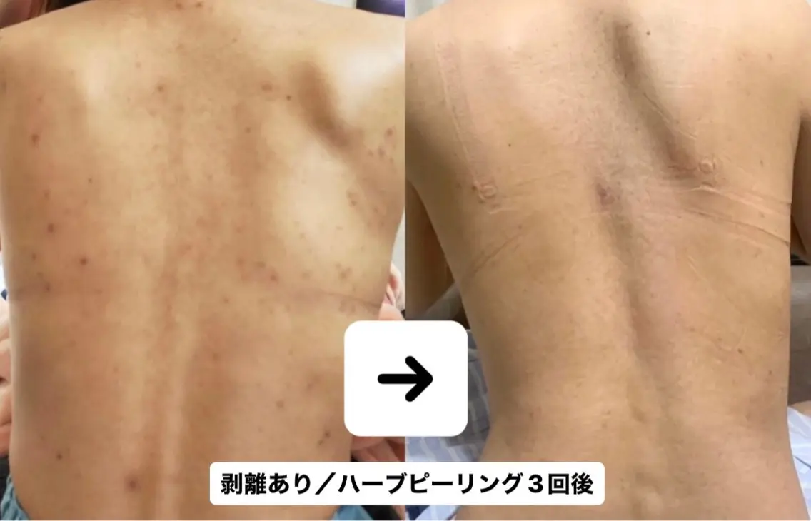 根本改善🌿業界初！！背中！！Verena処方式ハーブピーリング／剥離ありの写真