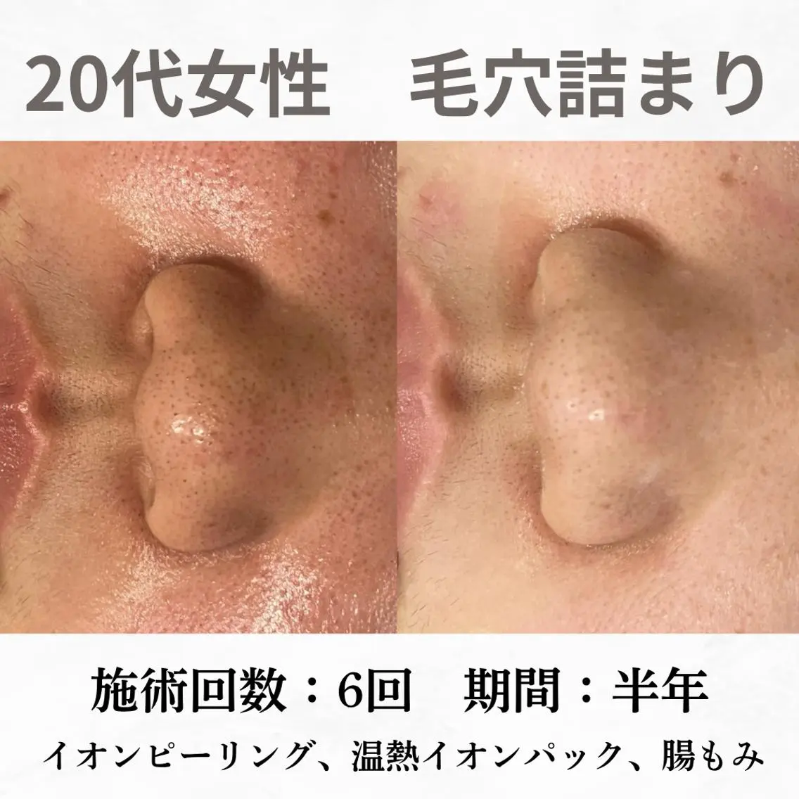 重度ニキビ専門🌷 ダウンタイムなしのエステ・リラクイメージ