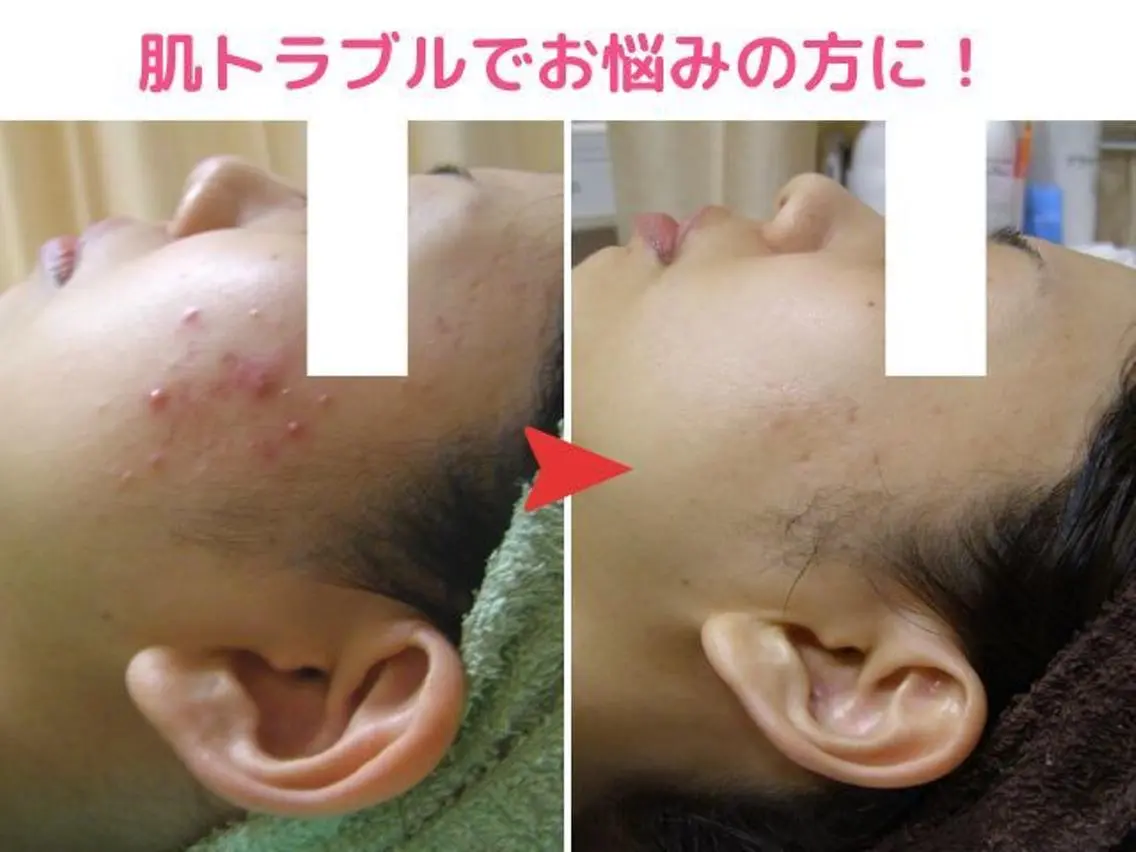 無剥離♪ハーブピーリングを超えた次世代艶肌シルクピーリング9900円☆ニキビやニキビ跡にもオススメ!の写真