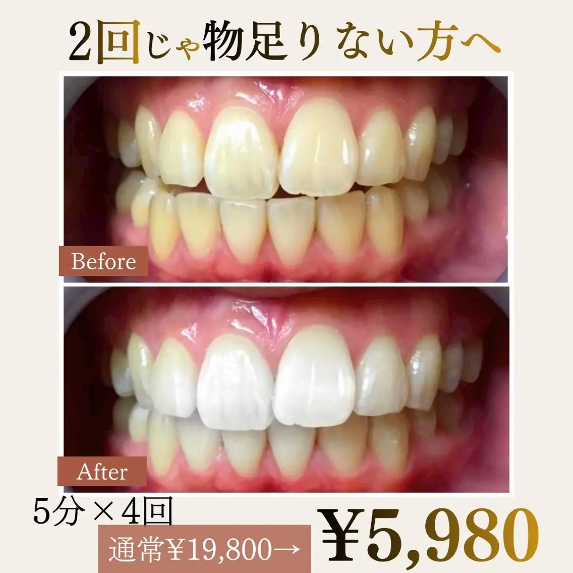 ⭐️【しっかり白くしたい方】5分×4回照射|ハイパワーセルフホワイトニング|通常¥19,800→初回¥5,980の写真