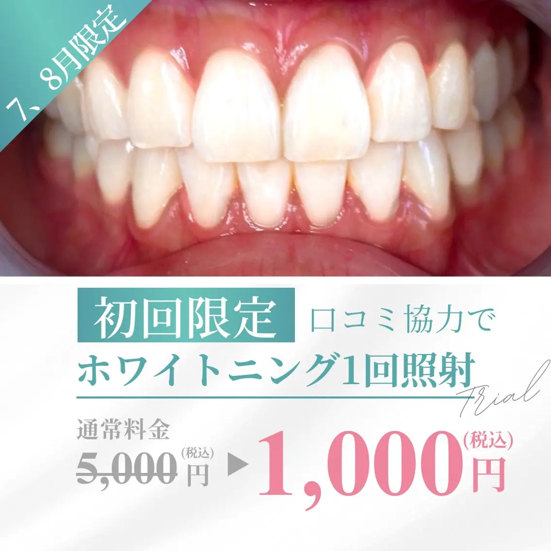 【7、8月キャンペーン】お試しホワイトニング　1回照射の写真