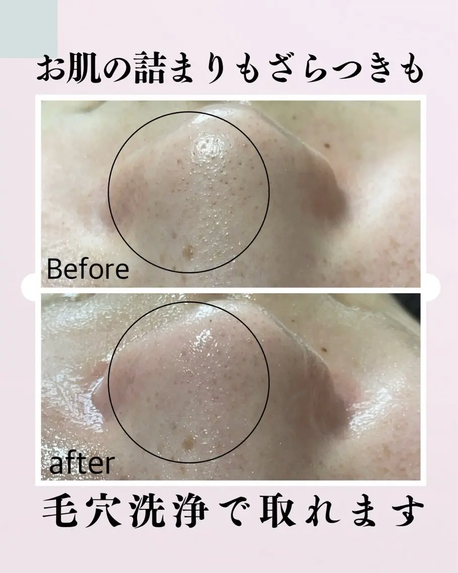 ニキビケア/くすみ/毛穴詰まり/いちご鼻に◎ 毛穴洗浄の写真