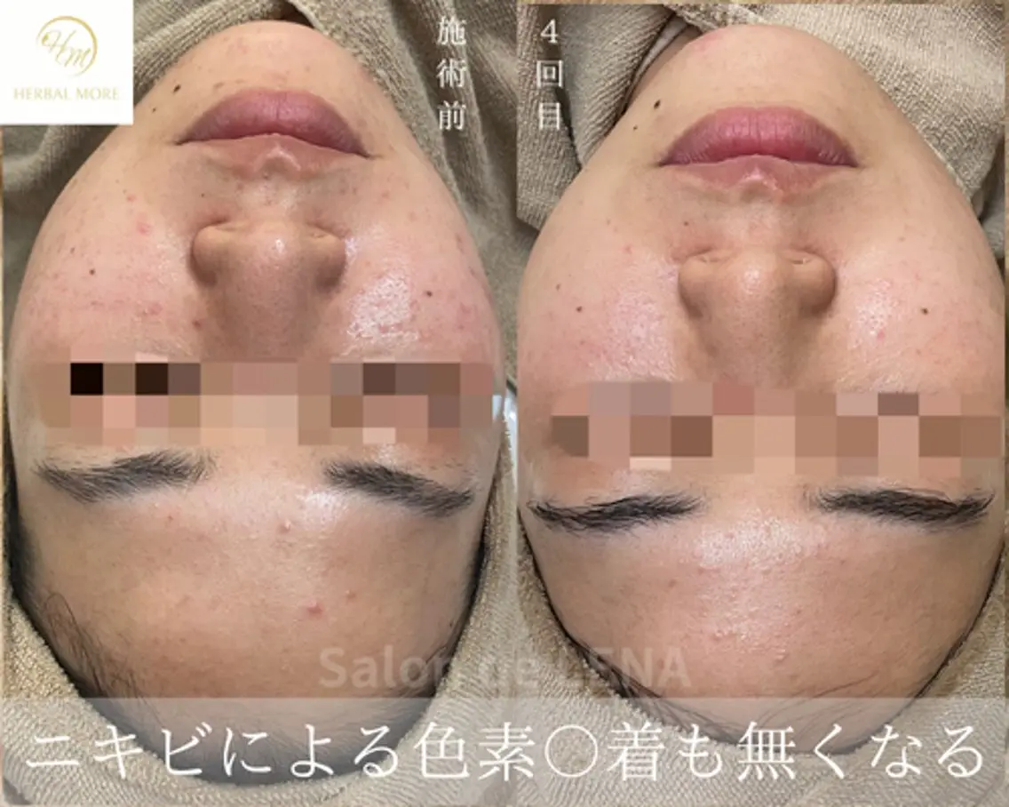 ハーブピーリング専門 サロンドレナ　白藤のエステ・リラクイメージ