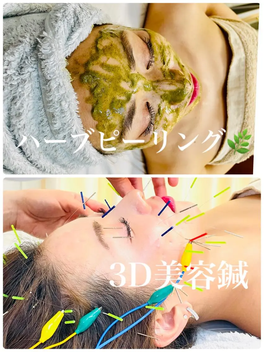 5月限定✨🌿無剝離ハーブピーリング×電気美容鍼🌿✨ツヤ感&すっきりフェイスラインケアの写真