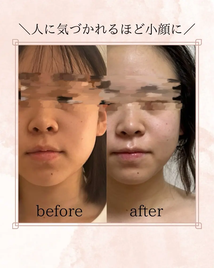 美容鍼WINBACK サロンRemeのエステ・リラクイメージ