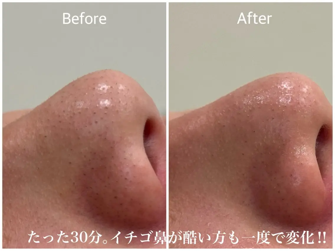 エステ 毛穴開き黒ずみ ニキビ特化💆♀️のエステ・リラクイメージ