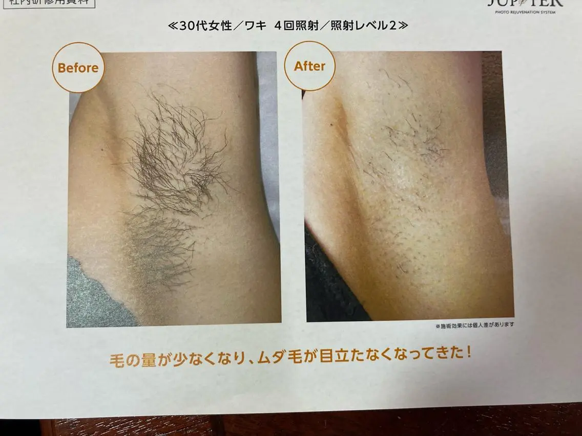 脱毛 伊藤 幸子のエステ・リラクイメージ