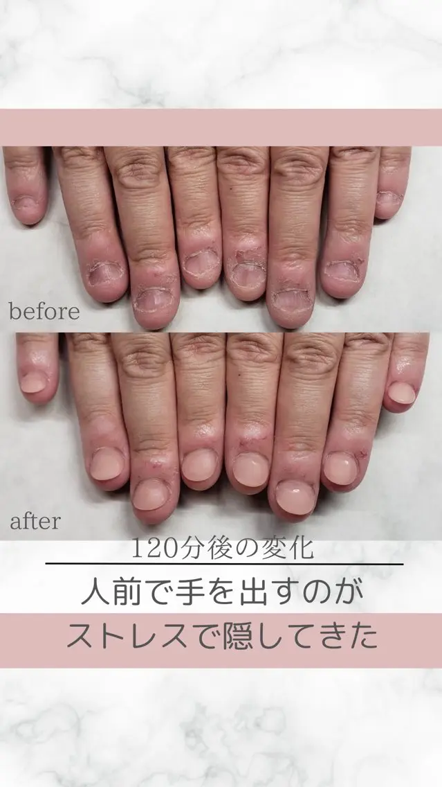 再発させない深爪矯正モニター(長さ出し3ミリ以下)自爪風も対応◎の写真