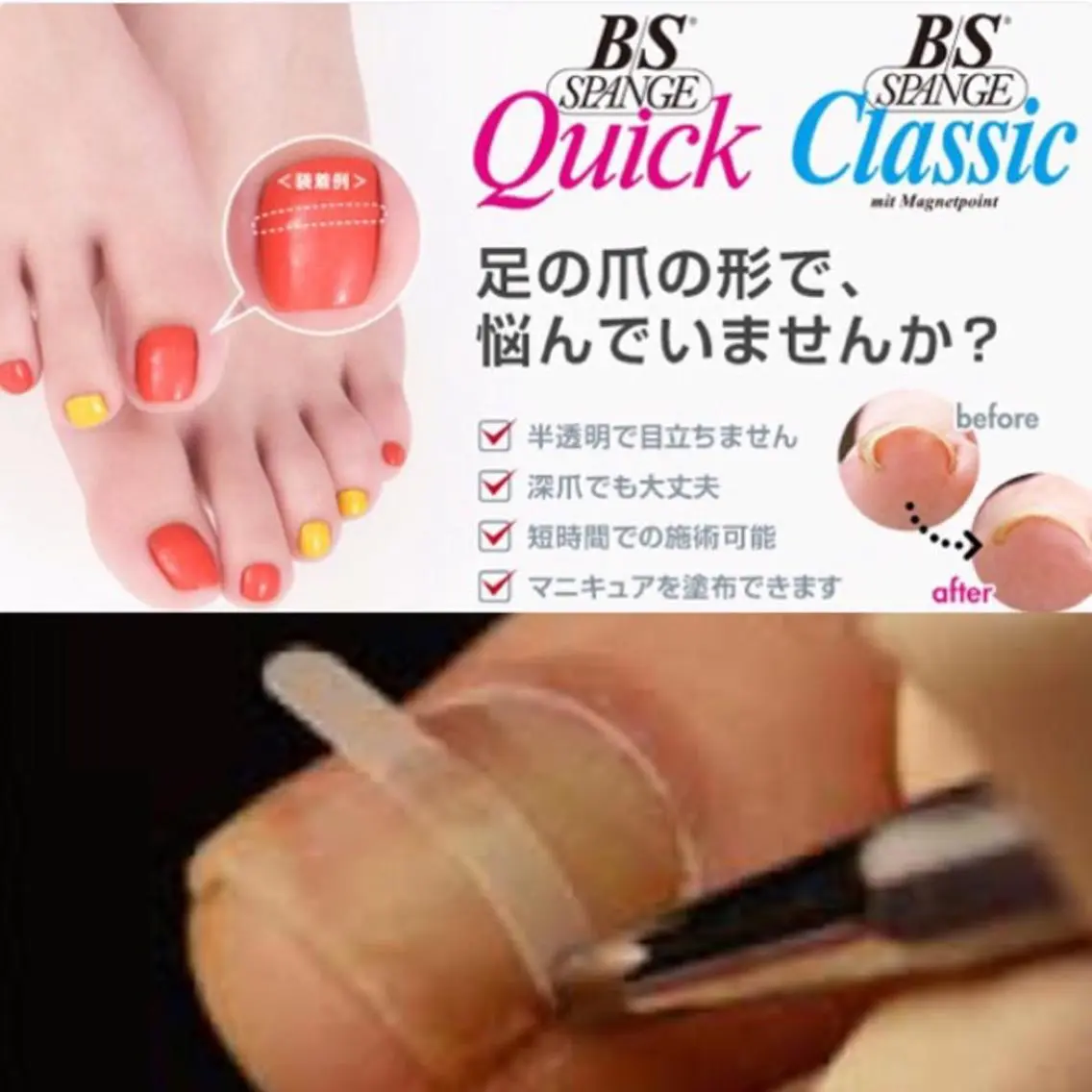 【✨巻き爪ケア✨】（BSスパンゲ）〈コーティング付き〉の写真