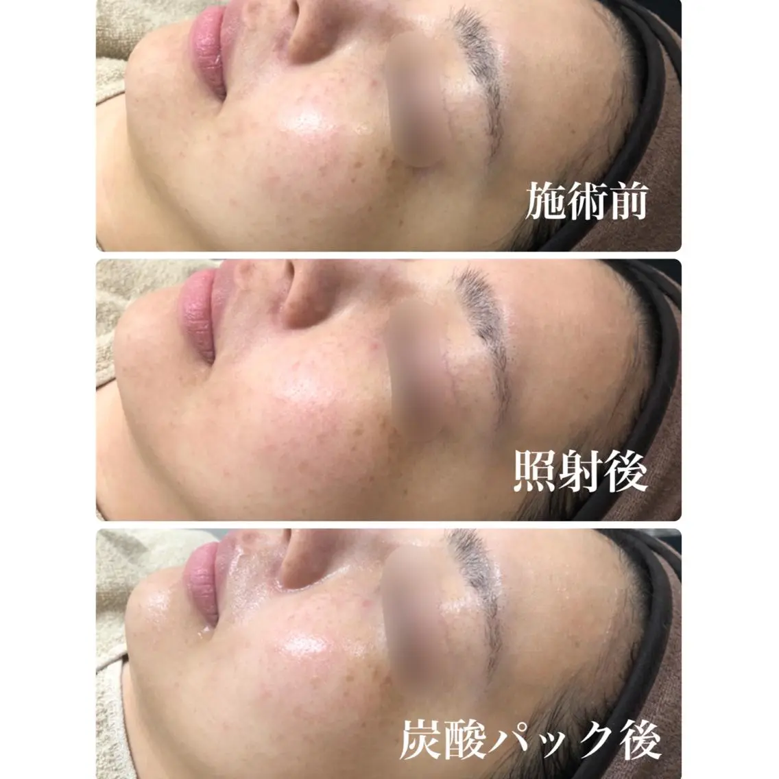 毎月10名様限定‼️光フェイシャル【くすみ/赤ら顔/シミ】コラーゲンの生成も促してお悩み改善♪の写真