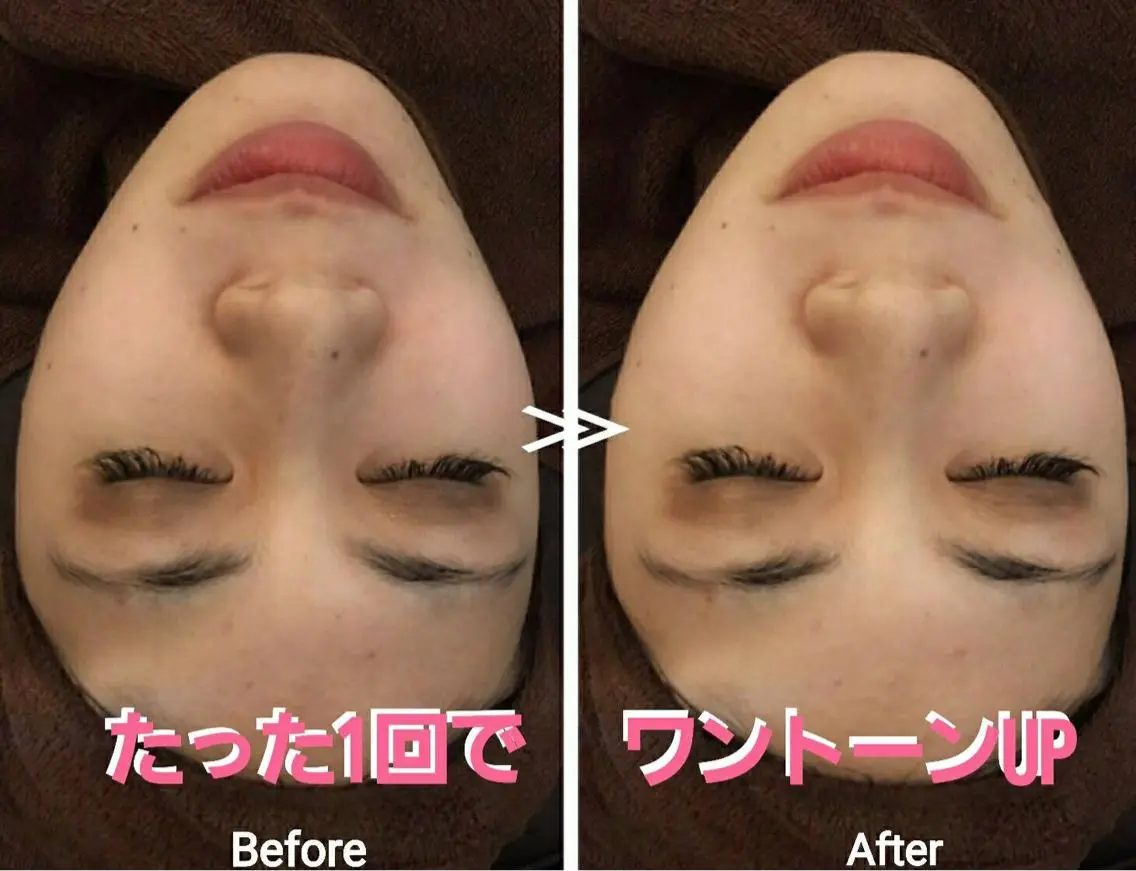 👑ミニモ限定特別メニュー👑✨毛穴洗浄スペシャル&脱毛カウンセリング✨❤️ 最新美容体験❣️満足度98%👑の写真