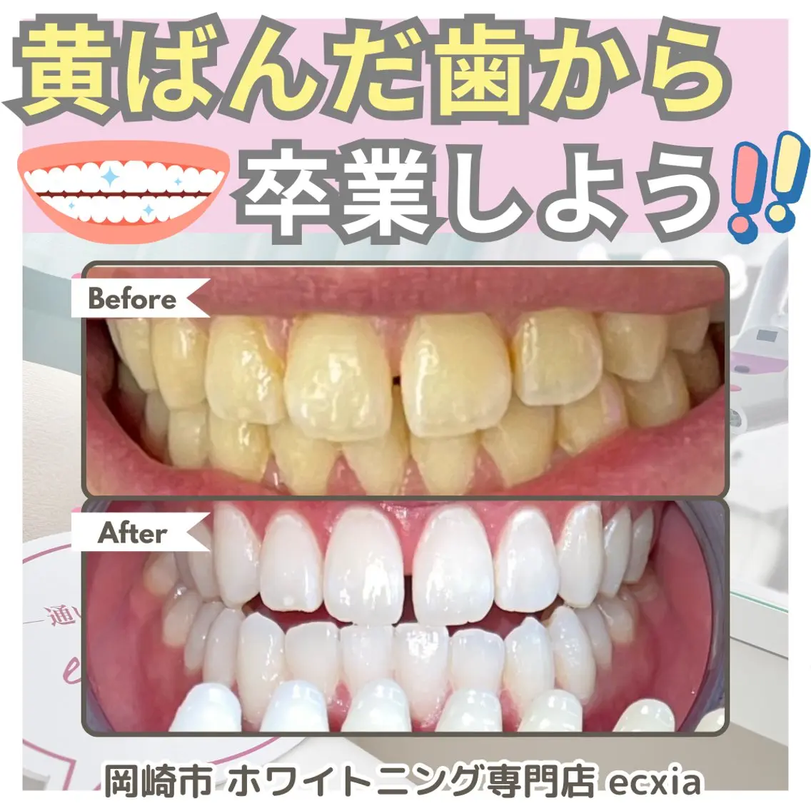 【お試し】高濃度プレミア歯科ホワイト60分✨️コーティング付き✨️【20分照射お試し🎶】白さの実感を✨️の写真
