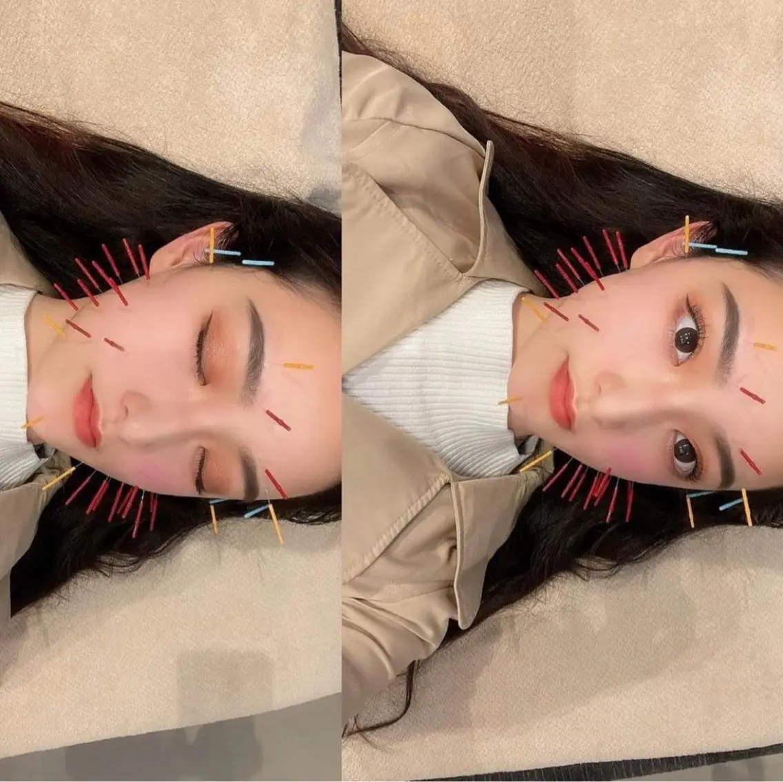 【むくみ・食いしばりが気になる方へ】オリジナル美容鍼　#小顔の写真