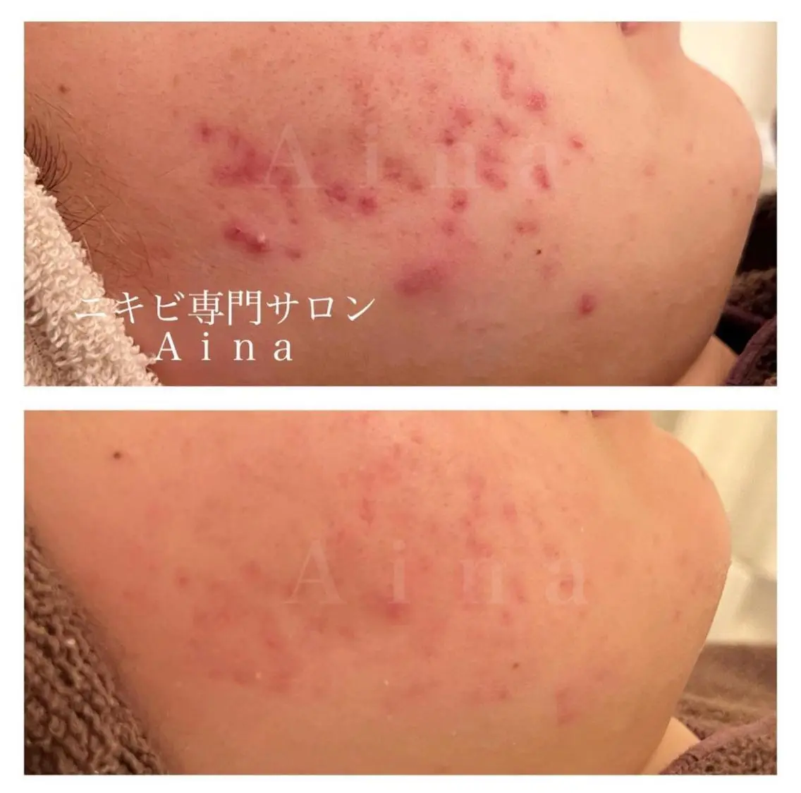 ショート カラー パーマ ヘアアレンジ メンズ キッズ ネイル マツエク・マツパ アイブロウ 赤色 ニキビ跡専門サロン Ainaのエステ・リラクイメージ