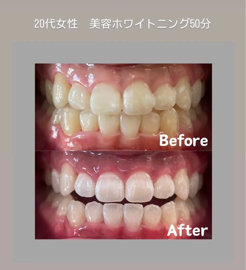 Kaula ホワイトニング🦷✨のその他イメージ