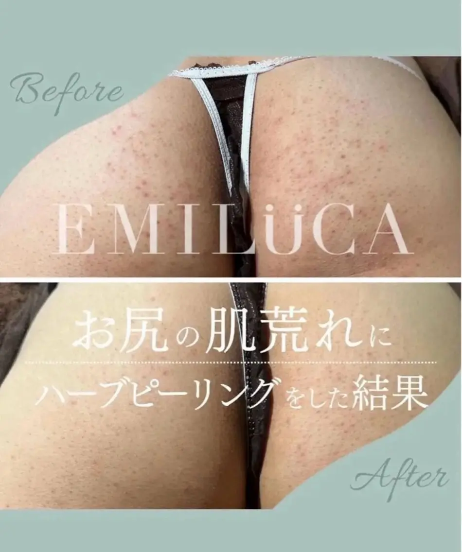 エステ ハーブピーリング🌿 EMILUCAのエステ・リラクイメージ