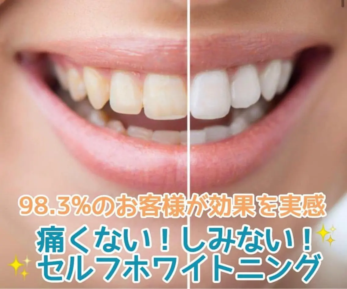 【1日1名様限定】Google口コミご協力クーポン！短期的に白くしたい方へ！ハイパワーホワイトニング10分✖️3照射✨の写真