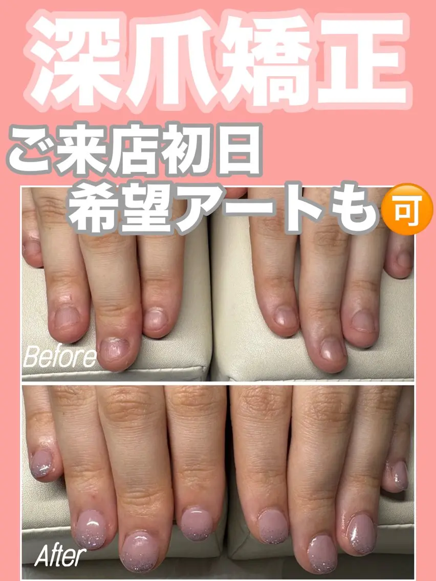 深爪矯正【長さ出し】◆カラーあり◆(オフ込)むしったり 割れたり 噛んで小さくなってしまった爪も美しく綺麗な状態に✧︎の写真