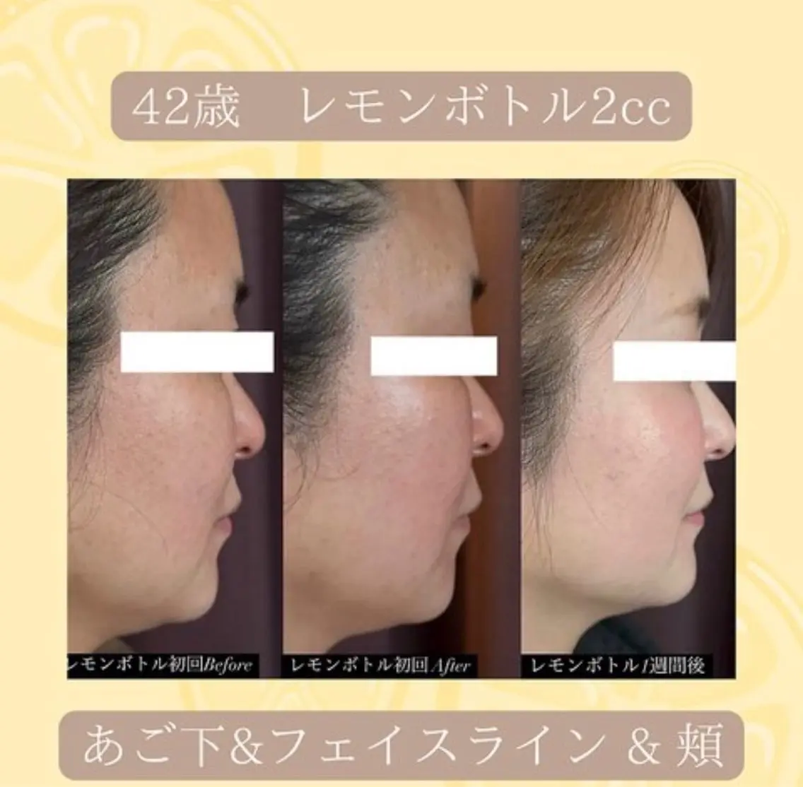 【速攻小顔】お顔の脂肪を撃退！2cc+ハイパーナイフ+小顔矯正の写真