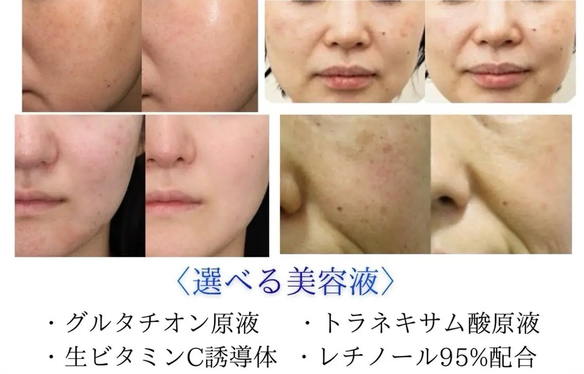 4つの美容液から選べるイオン導入💆‍♀️✨の写真