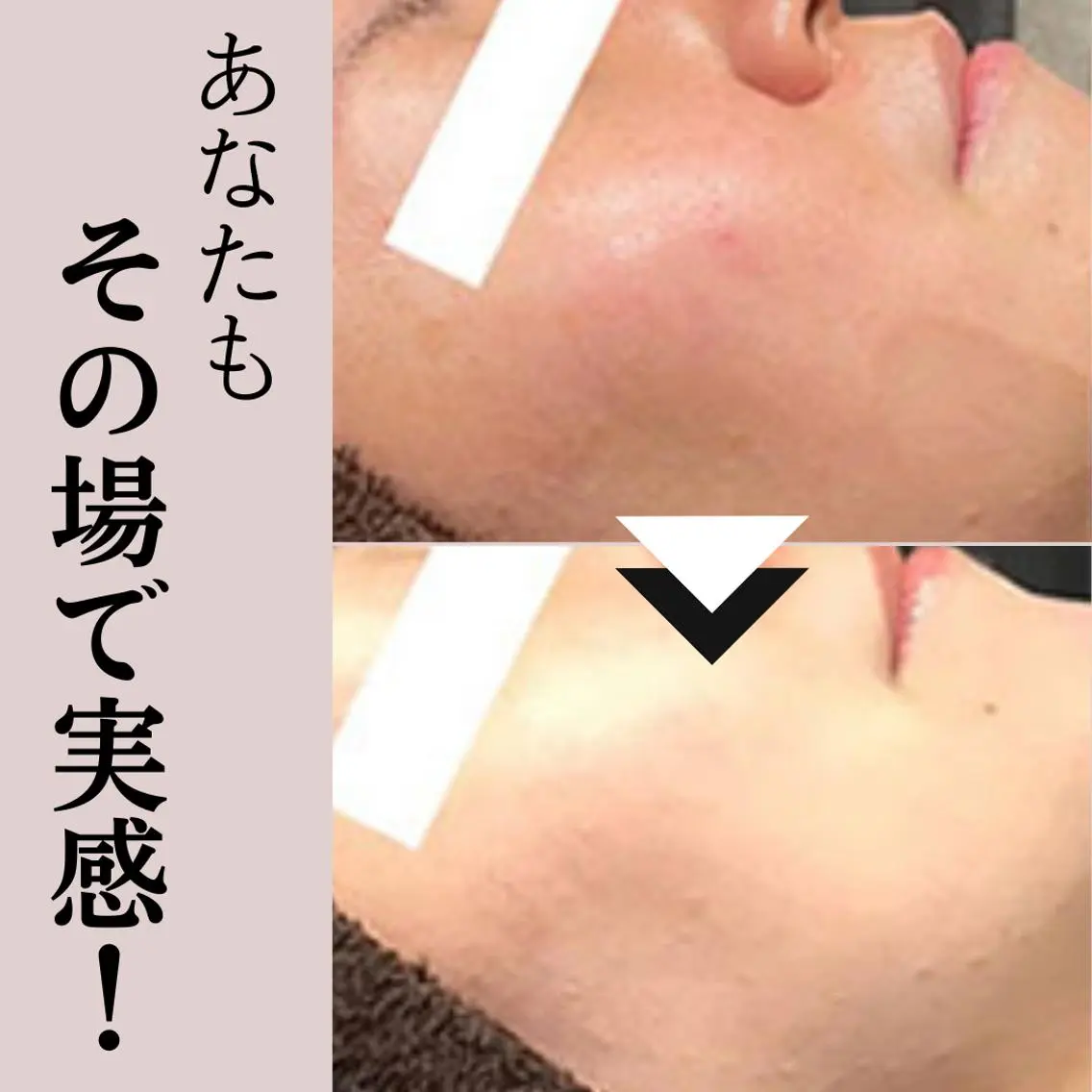 全顔吸引<<初回1回限り>>口コミ必須【体験モニター】今すぐ試したい!毛穴レスの感動体験の写真