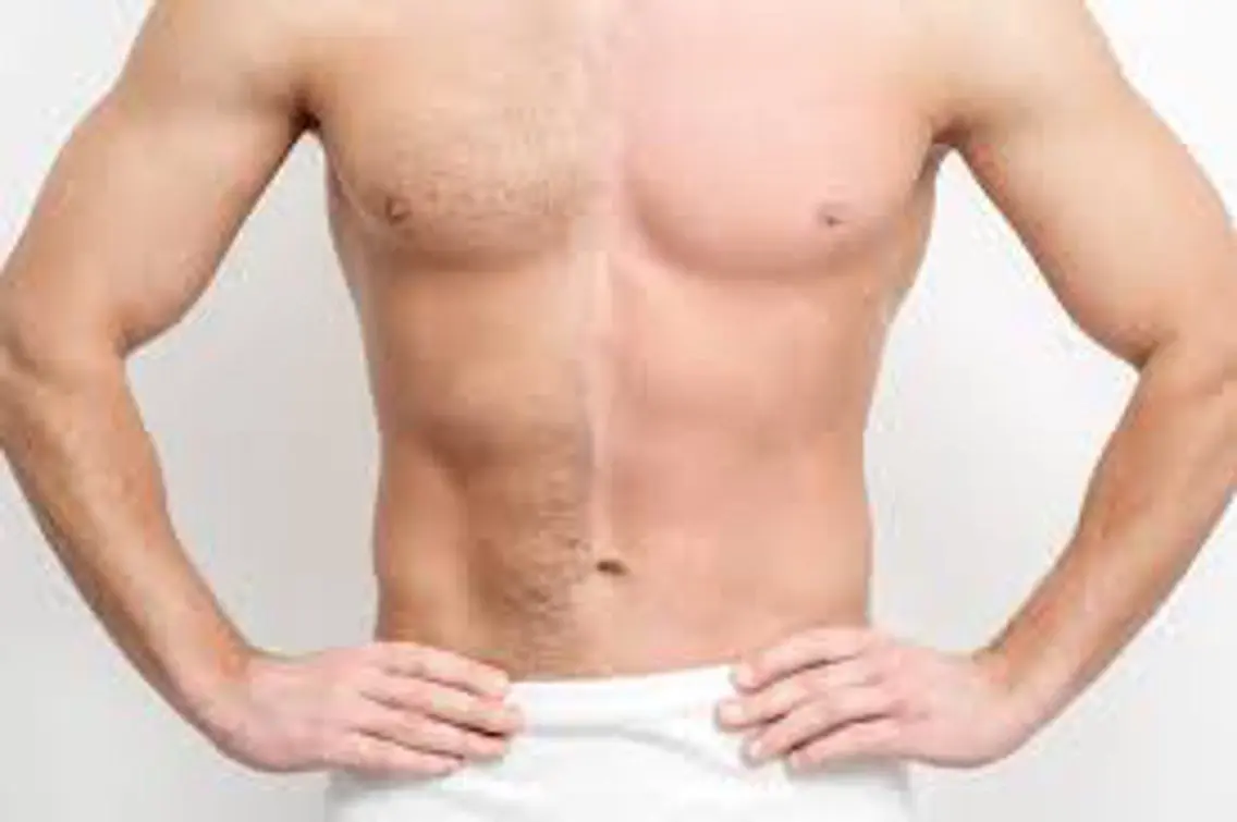 男性 胸・腹脱毛の写真