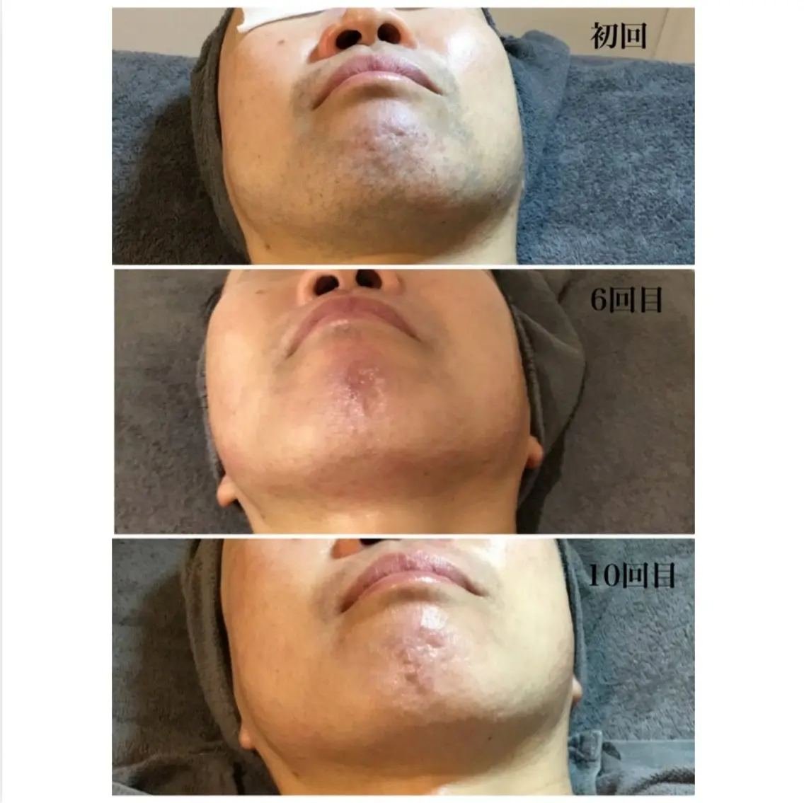 肌質改善エステ付き、メンズひげ脱毛の写真