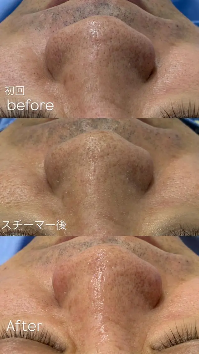 15分でできる毛穴矯正☆彡の写真